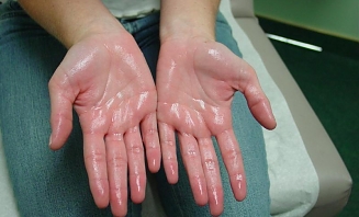 Nadměrné pocení 1