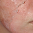 Chemický peeling 3