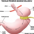 Bandáž žaludku 5