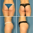Lipografting 3