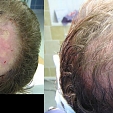 Transplantace vlasů 2