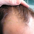 Transplantace vlasů 3