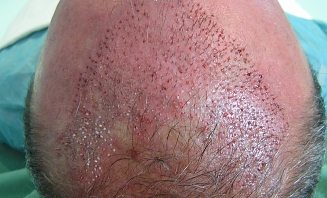 Transplantace vlasů 1