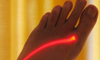 Laserové odstranění znamének 1