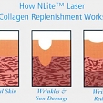 Odstranění jizev laserem 3