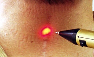 Odstranění jizev laserem 1