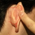 Operace odstátých uší 2