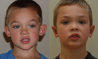 Operace odstátých uší 1