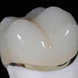 Zubní korunky 1