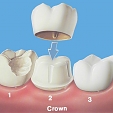 Zubní korunky 2