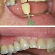 Zubní korunky 3