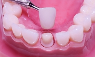 Zubní korunky 1