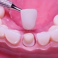 Zubní korunky 4