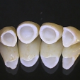 Zubní korunky 5